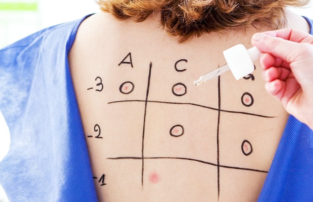 Skin Test vs. Blood Test: Which Test is Better?