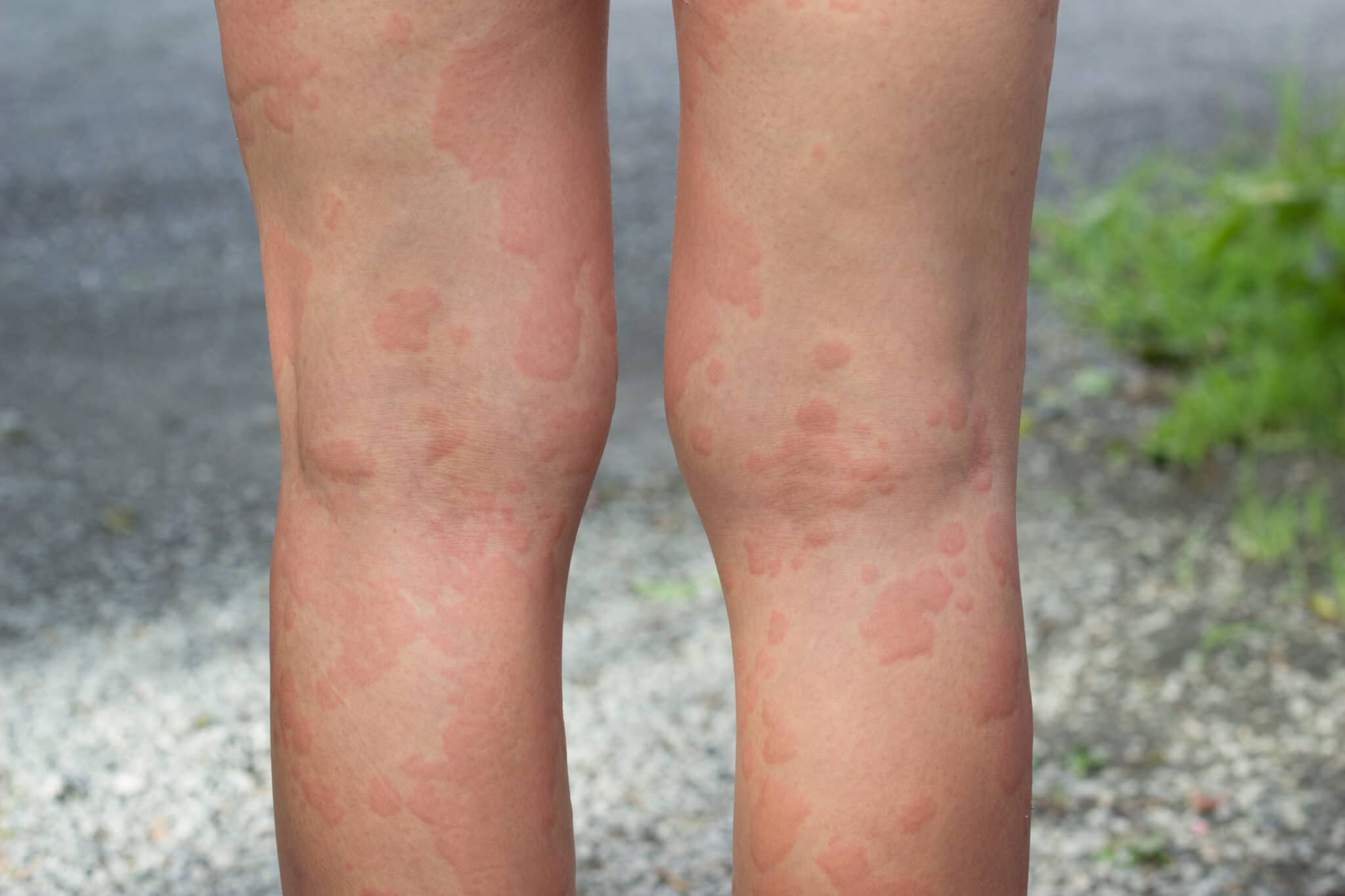 What Are Hives?