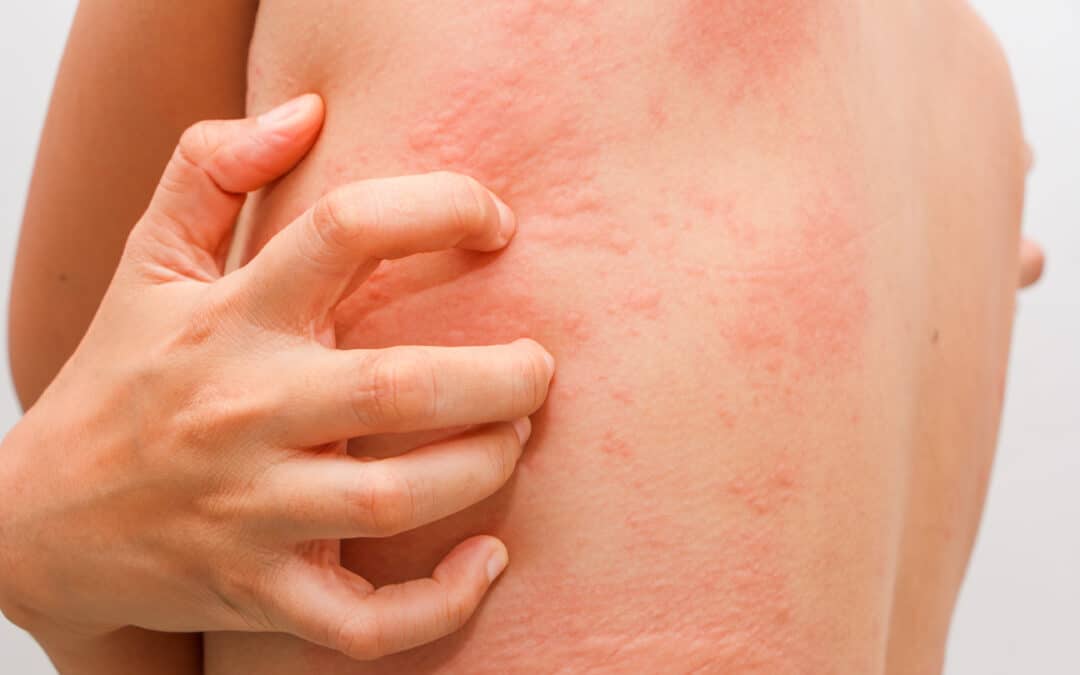 Hives Treatment: When to See Your Allergist